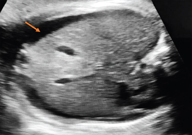 Foetal ascites.